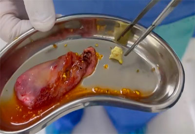 la litiasis vesicular